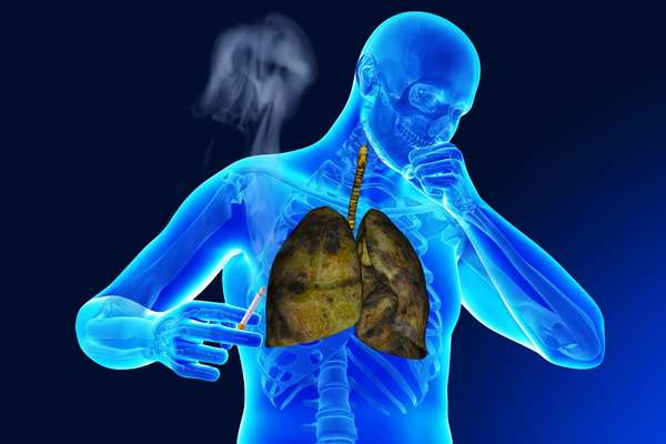 Elevado riesgo entre fumadores de sufrir un aneurisma de la aorta abdominal experto
