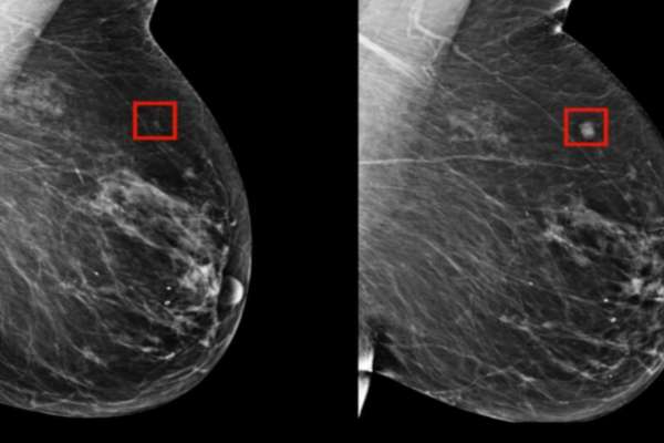 Inteligencia Artificial detectaría cáncer de mama hasta con 5 años de anticipación