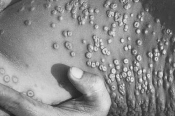 MPOX en México: ¿Qué hacer ante la enfermedad que está causando muertes en el país?